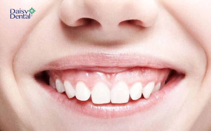 Răng ngắn gây mất cân bằng khuôn miệng