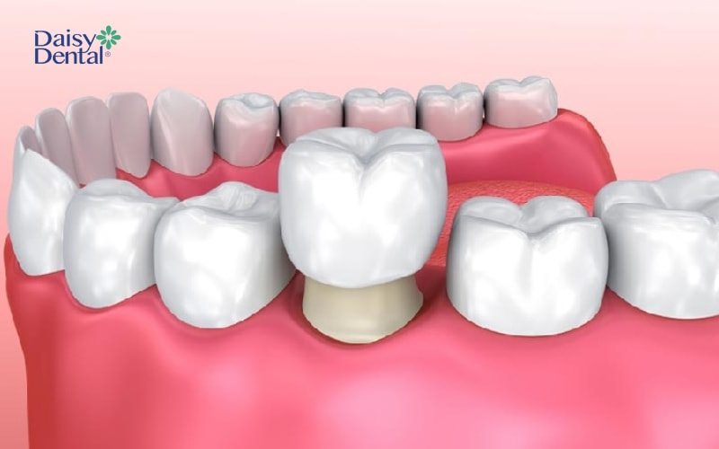 Răng sứ cho hiệu ứng như răng thật nhưng điểm hạn chế là phải mài răng