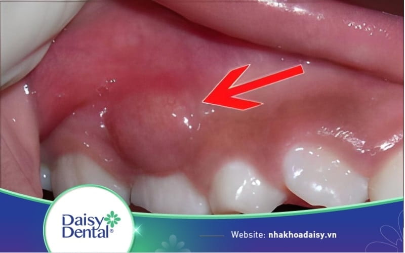 Hình ảnh áp xe răng thường thấy để nhận biết sớm bệnh lý