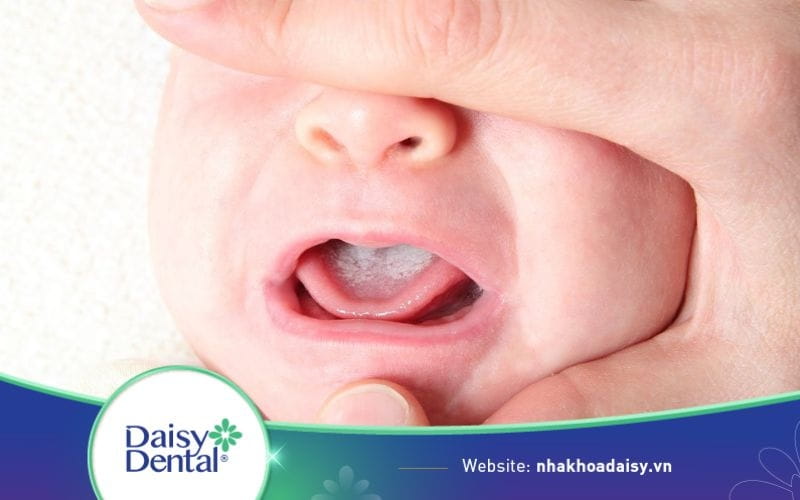 Hình ảnh các bệnh về lưỡi ở trẻ em