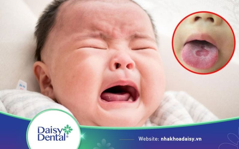 Hình ảnh nấm lưỡi ở trẻ