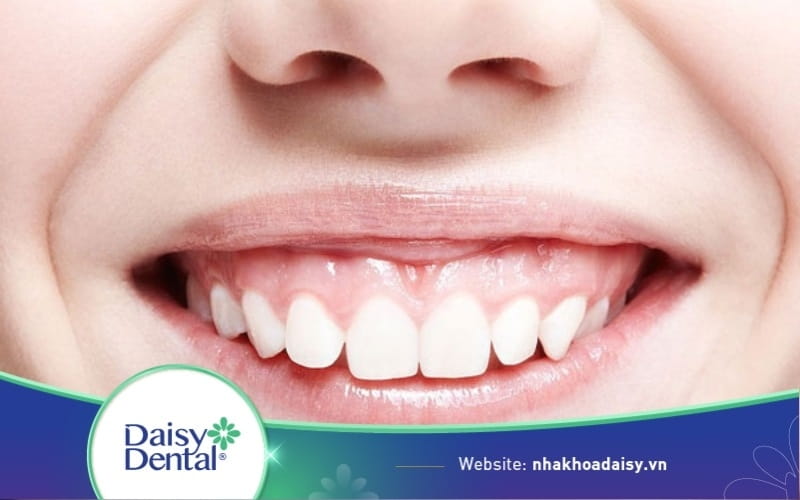 Răng ngắn cười hở lợi tướng số