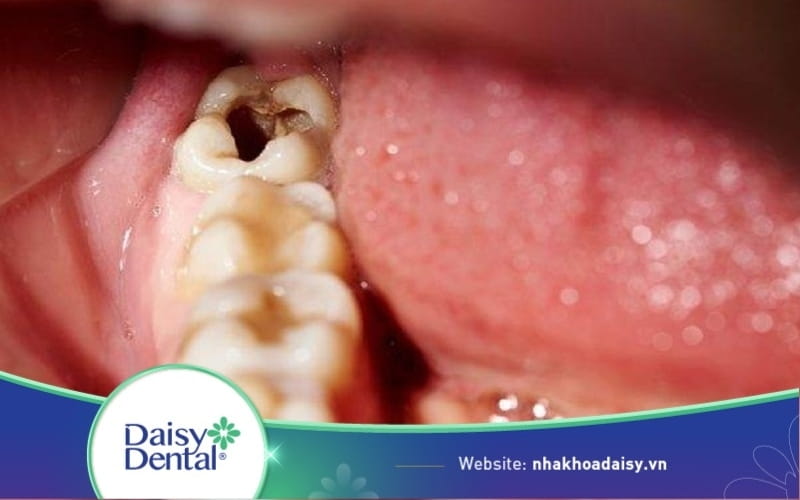Răng số 7 bị sâu vỡ