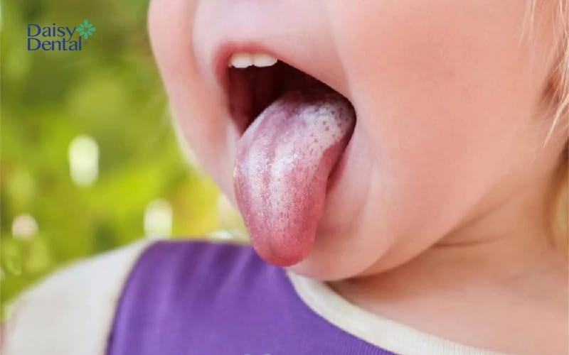 Trẻ có thể bị viêm lưỡi do nấm