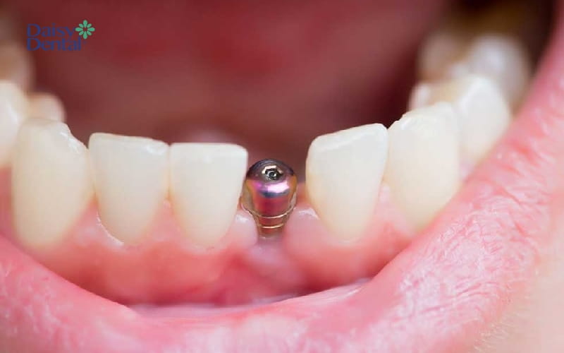 Trụ Implant đào thải cũng là một trong những lý do khiến răng giả bị rớt