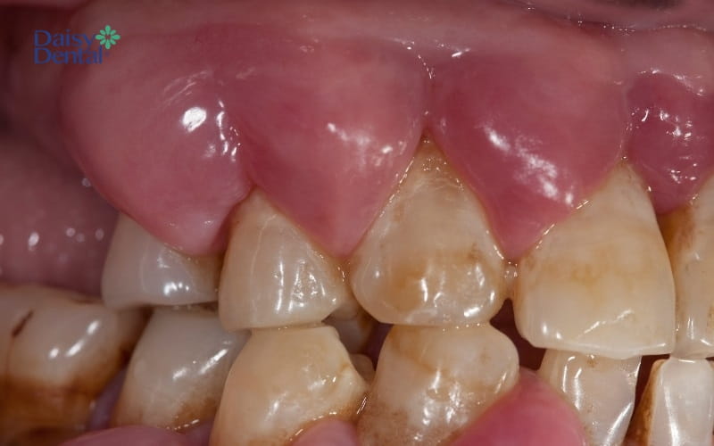 Túi nha chu to hình thành trên chân răng do tình trạng viêm lợi không được điều trị