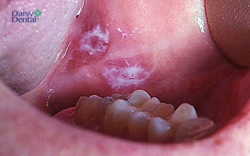 Ung thư khoang miệng làm nổi cục có thể bắt nguồn từ các vết loét trong khoang miệng