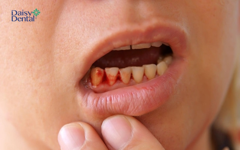 Xuất huyết chân răng là tình trạng xảy ra khá phổ biến, có thể gặp ở bất cứ ai