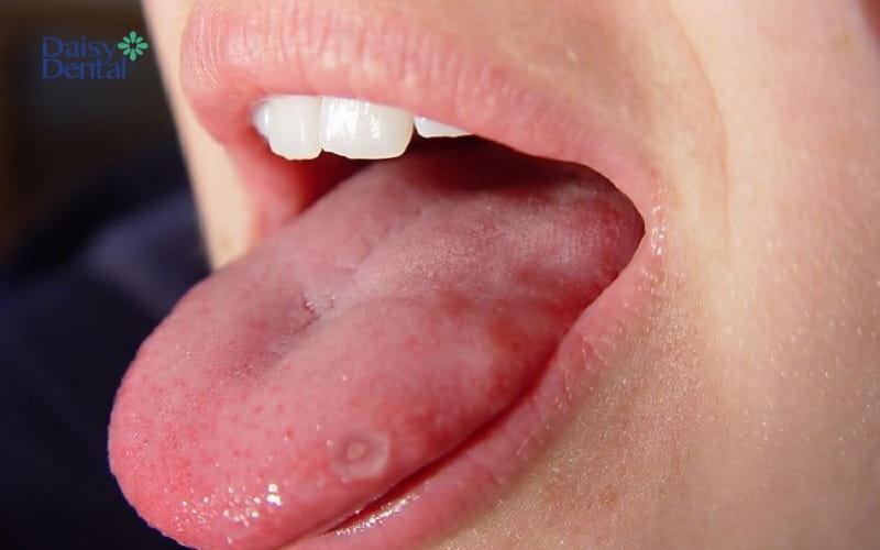 Lưỡi nổi mụn nước do nhiệt miệng thông thường