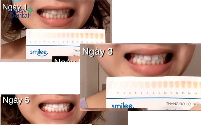 Màu sắc răng được cải thiện rõ rệt khi khách hàng sử dụng Smilee một thời gian