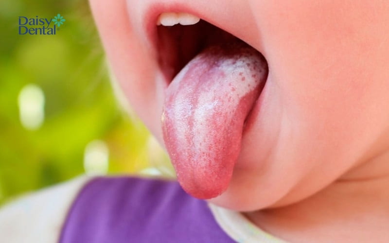 Nấm miệng hay tưa lưỡi là bệnh lý xuất hiện khá phổ biến, đặc biệt là ở trẻ nhỏ