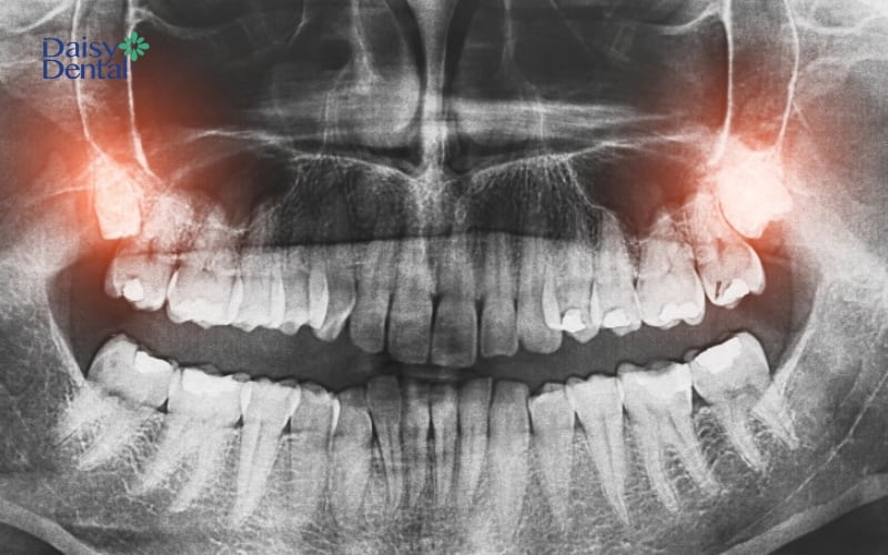 Nhổ răng khôn hàm trên sẽ không nguy hiểm như khi thực hiện nhổ răng khôn hàm dưới