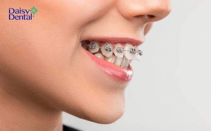 Niềng răng là phương pháp nha khoa khắc phục hiệu quả tình trạng răng cửa bị hô, to