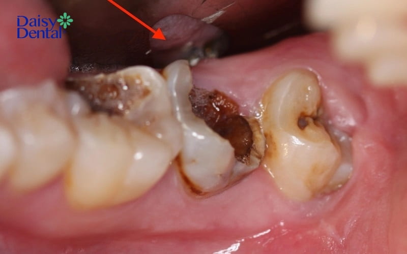 Răng hàm bị sâu nặng sẽ cần được nhổ bỏ để tránh mô sâu lan ra những chiếc răng khác