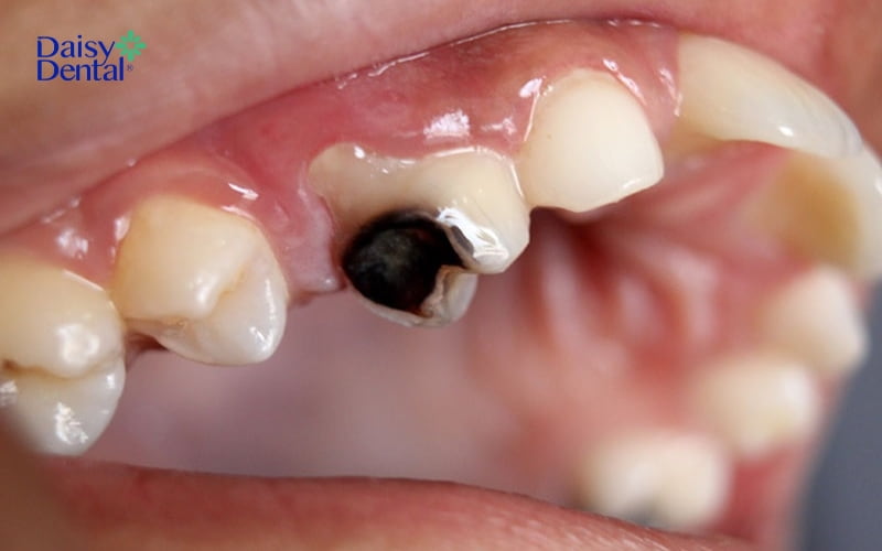 Răng sâu nặng có màu đen gần hết thân răng
