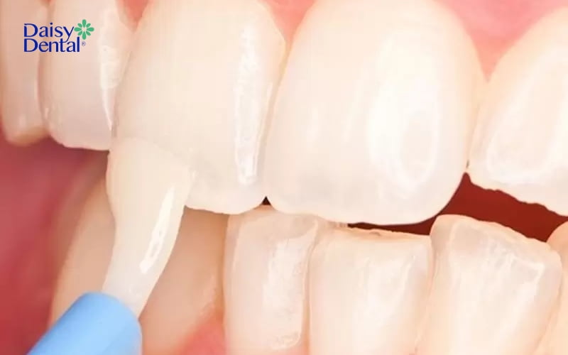 Tái khoáng men răng giúp răng trắng khỏe hơn