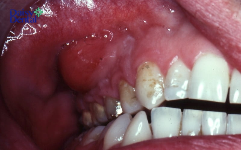Áp xe chân răng xuất hiện do nhiễm khuẩn diễn ra trong thời gian dài