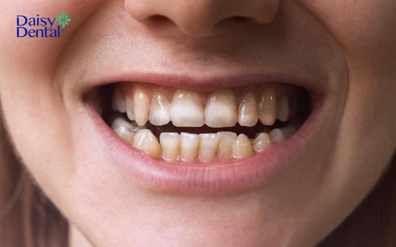 Men răng bị tổn thương hoặc mài mòn sẽ dễ bị ê buốt và đau nhức