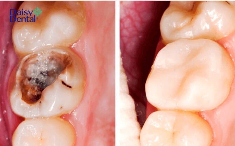 Mô răng sâu sẽ được loại bỏ và phục hình để cải thiện cơn đau nhức, khó chịu