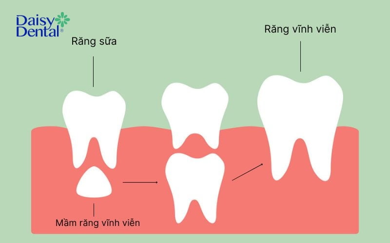 Nếu không có mầm răng vĩnh viễn, răng sữa sẽ tồn tại đến khi trưởng thành