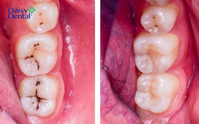 Nha sĩ tiến hành điều trị sâu răng để ngăn chặn tình trạng viêm nhiễm lan rộng