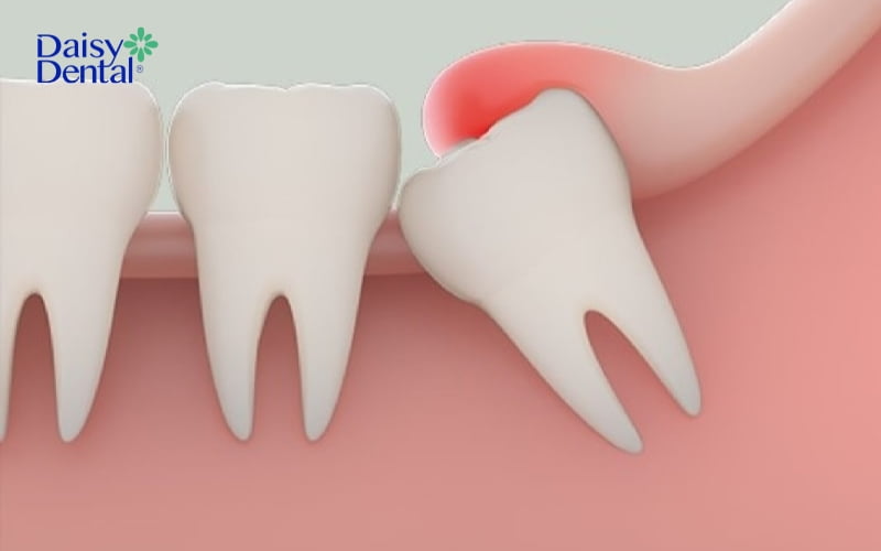 Nhiều người mọc răng khôn có thể bị nổi mụn ở nướu răng