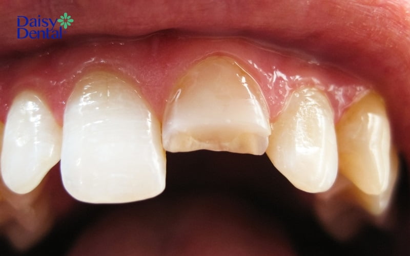 Răng bị gãy có thể bị ê buốt, đau nhức khi có kích thích từ bên ngoài
