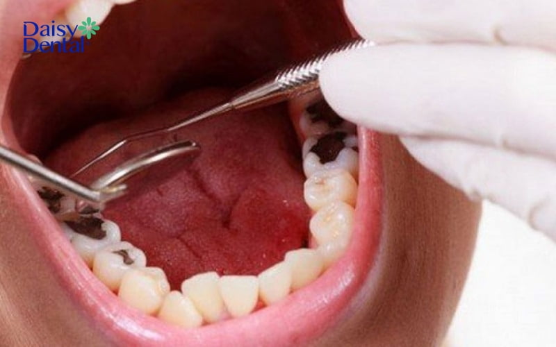 Sâu răng là nguyên nhân phổ biến khiến răng trở nên nhạy cảm hơn
