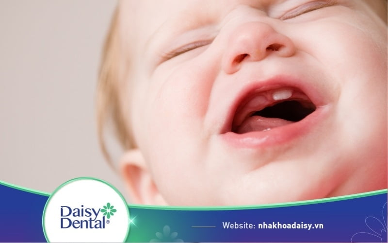 Trẻ mọc răng hàm trên trước