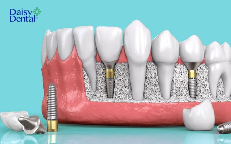 Trồng răng Implant - Phương pháp khắc phục thiếu răng hiệu quả