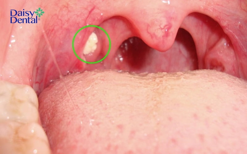 Cục màu trắng trong khoang miệng có thể là do các mô mềm tại khu vực ấy bị tổn thương