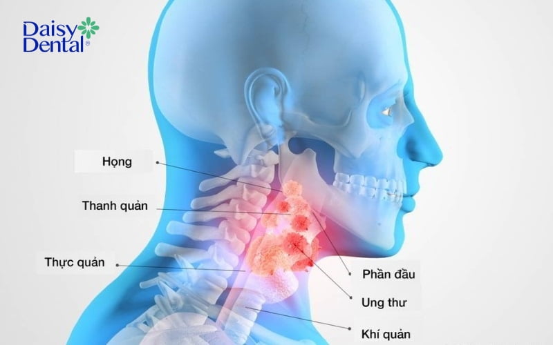 Dây thanh quản là bộ phận trong cổ họng dễ gặp phải tình trạng viêm nhiễm, ung thư