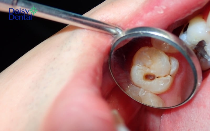 Hình ảnh răng bị sâu ở giai đoạn hai, mô răng sâu có thể nhận thấy bằng mắt thường