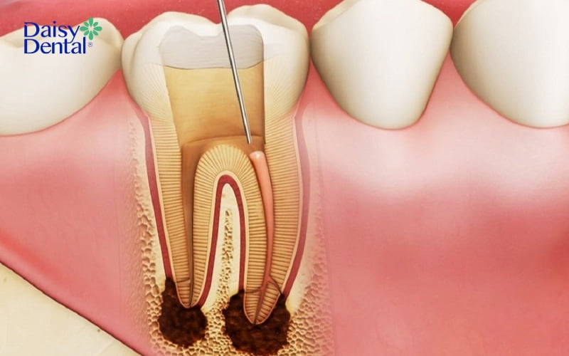 Lấy tủy răng là phương pháp loại bỏ phần tủy răng bị viêm