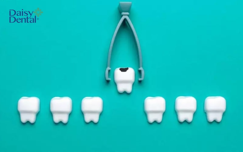Nếu răng bị sâu nghiêm trọng, bác sĩ buộc phải nhổ bỏ răng