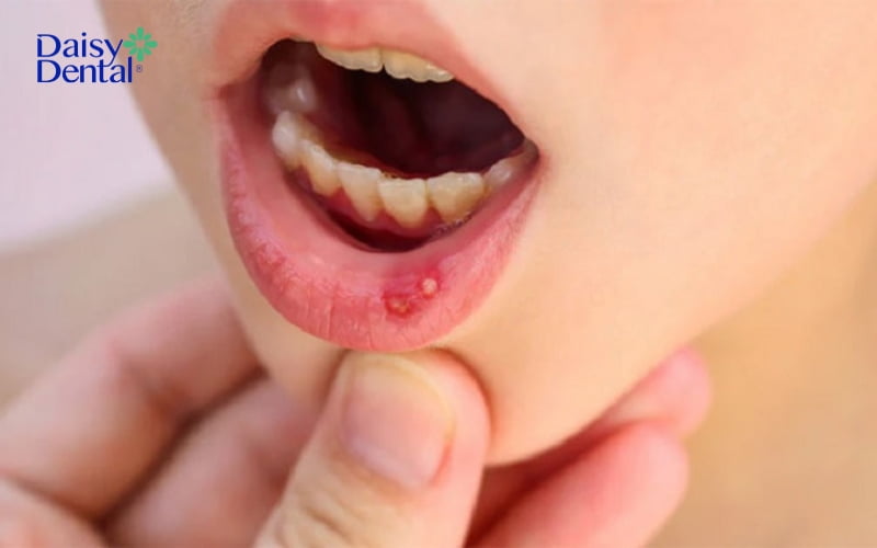 Nhiệt miệng thường có biểu hiện là nốt mụn màu trắng có viền đỏ xung quanh