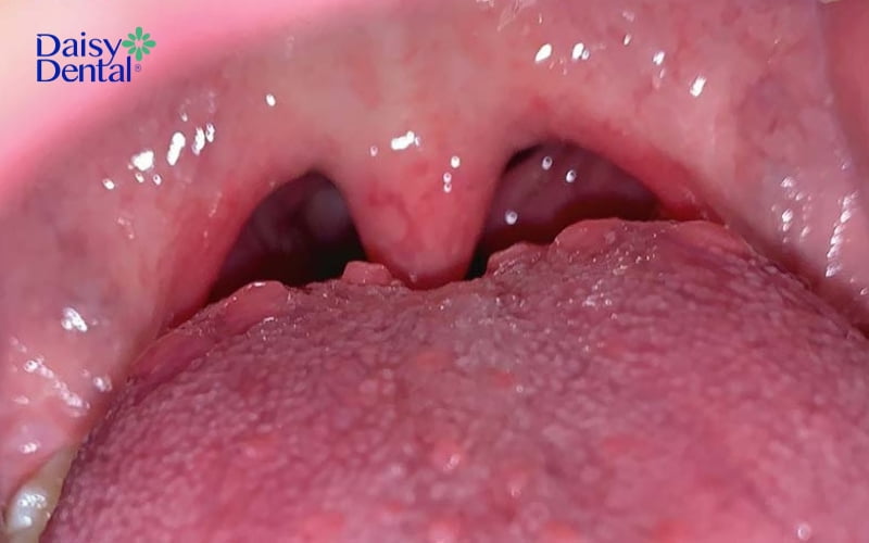Nổi mụn ở cuống lưỡi có thể là dấu hiệu của bệnh sùi mào gà