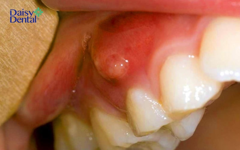 Nốt mụn có thể mọc trên nướu răng