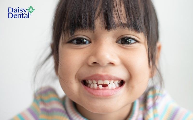 Răng sữa là những chiếc răng đầu tiên xuất hiện trên cung hàm