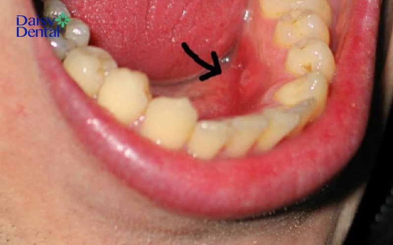 Trường hợp nổi mụn trong miệng gây đau rát