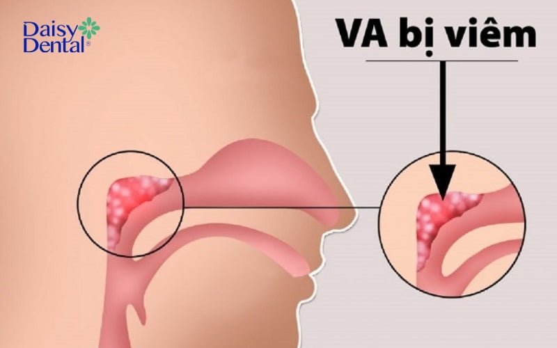 VA có thể bị sưng viêm do sự tấn công của vi khuẩn, vi trùng