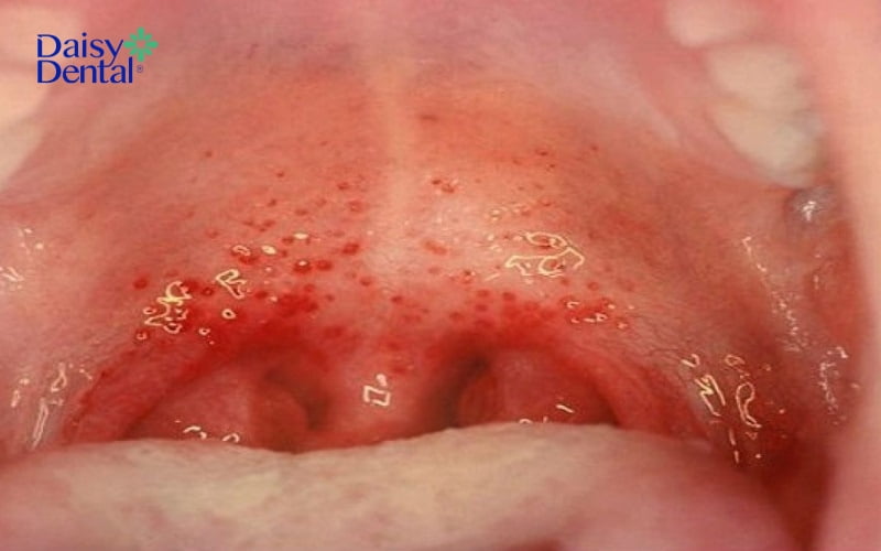 Viêm họng là bệnh lý liên quan đến cổ họng có thể gặp phải bất kỳ ai