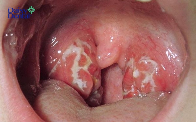 Viêm họng trong thời gian dài sẽ phát triển thành bệnh lý viêm họng hạt