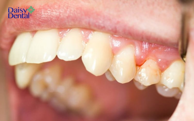 Bệnh nha chu là nguyên nhân dẫn đến mủ ở chân răng