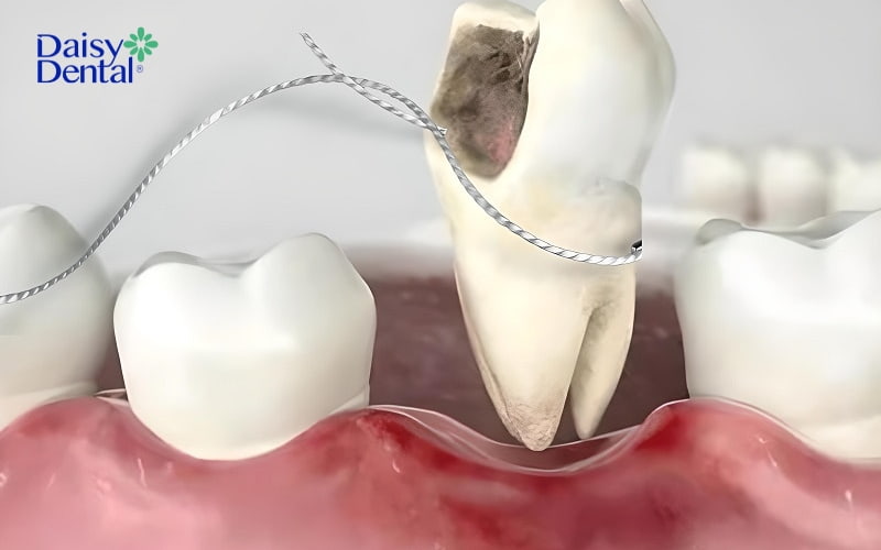 Cách nhổ răng hàm bị sâu bằng chỉ tại nhà được nhiều bạn thực hiện