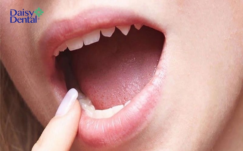 Niêm mạc miệng là lớp mô mềm bao bọc xung quanh miệng