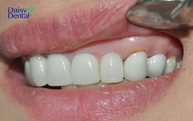 Răng giả không sát khít với hàm răng thật sẽ dẫn đến ngứa ngáy, khó chịu