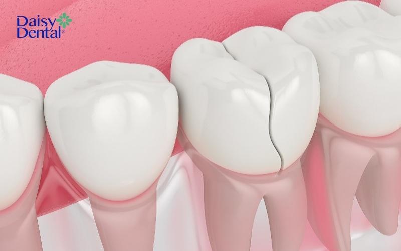 Trường hợp vết nứt chia răng làm 2 phần, người bệnh nên nhổ răng