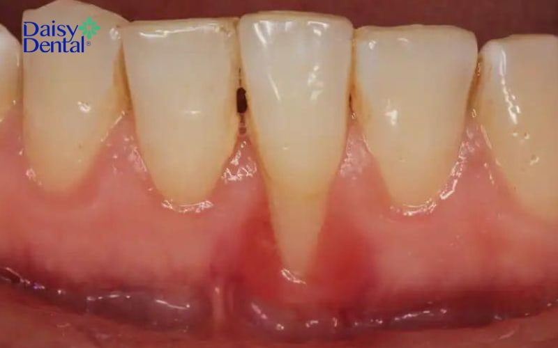 Viêm loét nướu thường gây ra hiện tượng ngứa chân răng