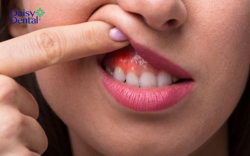Viêm nướu cũng là một trong những nguyên nhân gây đau nhức răng